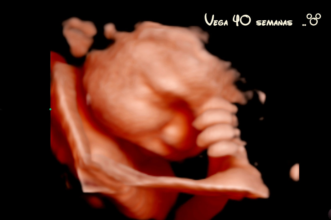 Ecografía prenatal mostrando manos y rostro del bebé en Arroyomolinos Madrid